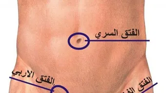 ما هو الفتق