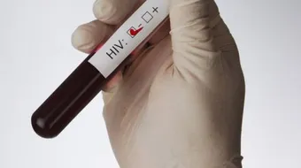 ما هو تحليل HIV