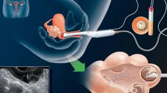 ما هو الحقن داخل الرحم