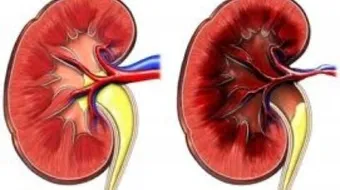 ما هو تليف الكلى