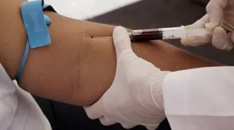 ما هو تحليل LDH