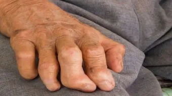 ما هو مرض الجذام