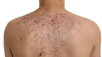 ما هو الجذام