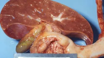 ما هي دهون الكبد