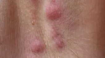 ما هو ورم الغدد اللمفاوية