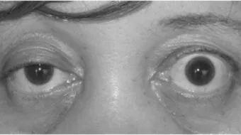 ما هو مرض الوهن العضلي