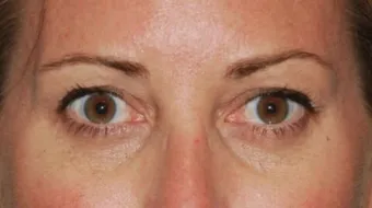 ما هو الوهن العضلي