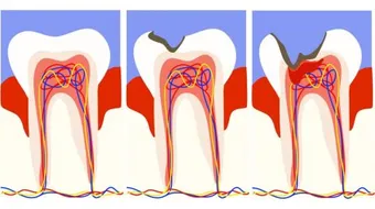 ما هو حشو العصب