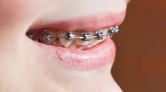 ما هو تقويم الاسنان