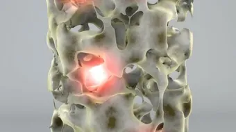 ما هي هشاشة العظام