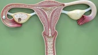 ما هو تكيس المبايض وعلاجه