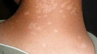 ما هو مرض النخالية البيضاء