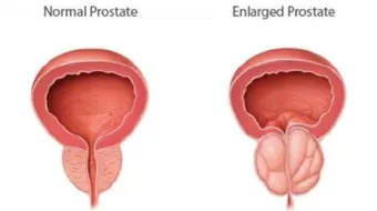 ما هو مرض البروستات