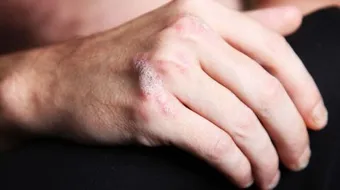 ما هي الصدفية وما علاجها