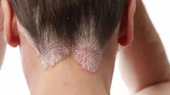 ما هي صدفية الشعر