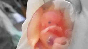 ما هو الاجهاض المتكرر وما اسبابه