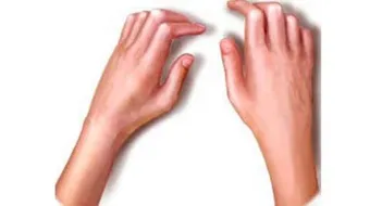 ما هو الروماتيزم