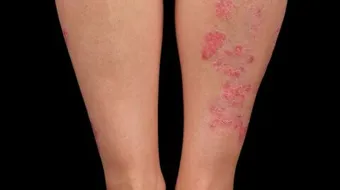 ما هي الأكزيما الجلدية