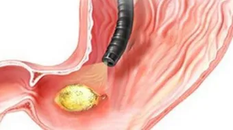 ما هي جرثومة المعدة