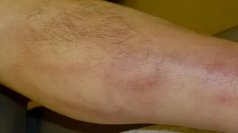 ما هو إلتهاب الوريد الخثاري السطحي