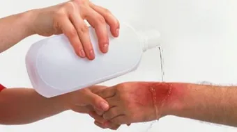 ما هو أفضل علاج للحروق