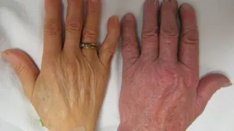 ما هو سبب فقر الدم