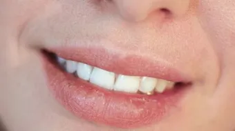 ما سبب تشقق الشفاه