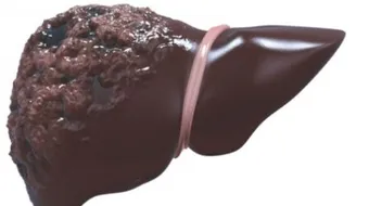 ما سبب تليف الكبد