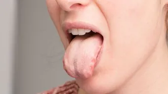 ما هو سبب تشقق اللسان