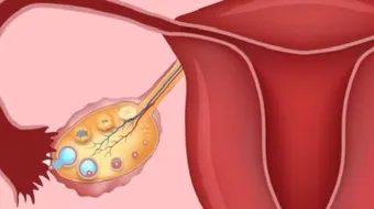 ما سبب ظهور أكياس المبيض