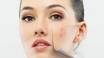 ما سبب الحبوب في الوجه