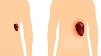 ما هو سبب تضخم الطحال