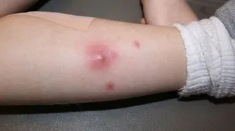 ما هو سبب ظهور الدمامل