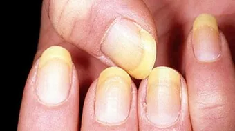 ما هو سبب إصفرار الأظافر