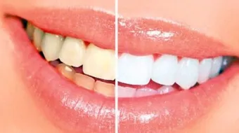 ما هو سبب اصفرار الأسنان