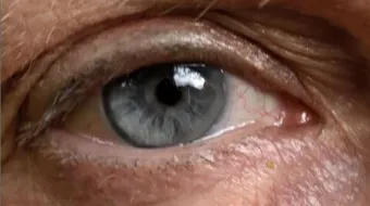 ما هو سبب صفار العين