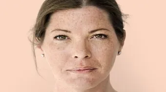 ما هو كلف الحمل