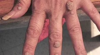 ما علاج الثالول