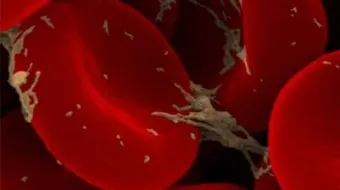 ما هو تعريف سرطان الدم