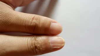 ما تأثير نقص الحديد على الجلد والشعر والأظافر