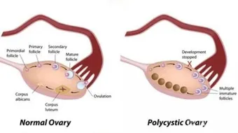 ما هي اضرار تكيس المبايض
