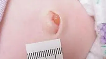 ما هو فتق الرياضيين