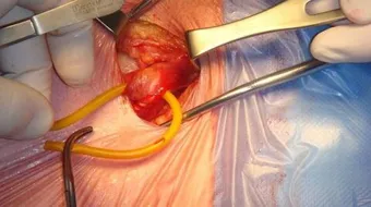 ما هي عملية الفتاق