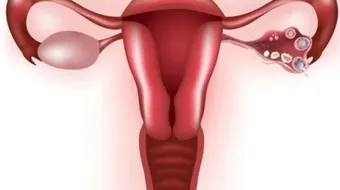 ما معنى تكيس المبايض