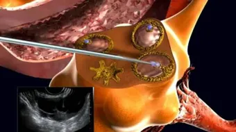 ما هي عملية الحقن المجهري