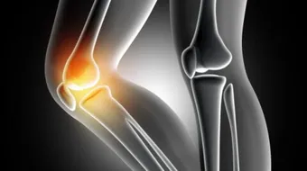 ما سبب طقطقة المفاصل