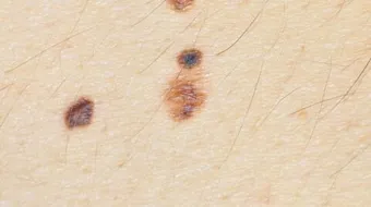 ما هو سبب ظهور الشامات