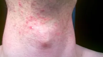 ما سبب ظهور الحبوب في الرقبة