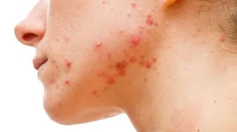 ما هو سبب ظهور الحبوب في الوجه