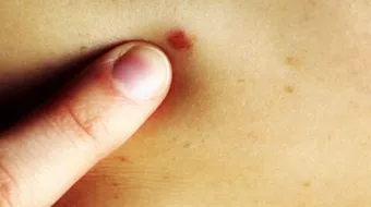 ما هو سبب ظهور نقط حمراء على الجلد